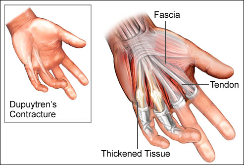 can't bend finger all the way down
