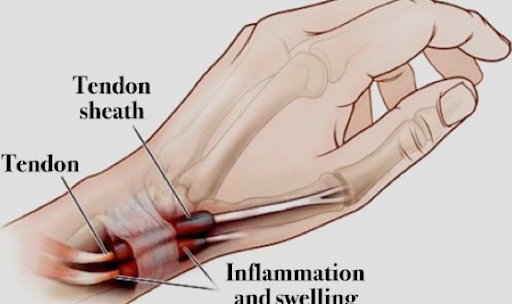 tendonitis in hand